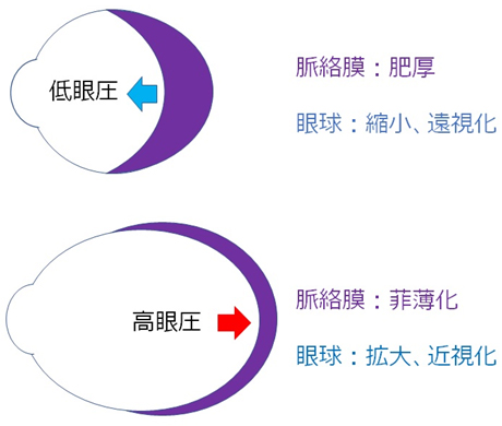 緑内障における脈絡膜深部血流の意義について