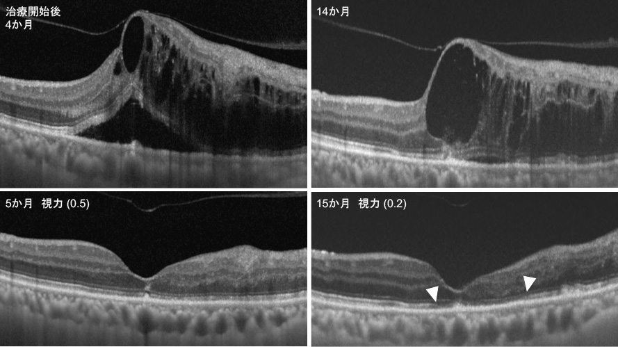 図2. 繰り返す黄斑浮腫の再発によって進行した中心窩視細胞障害