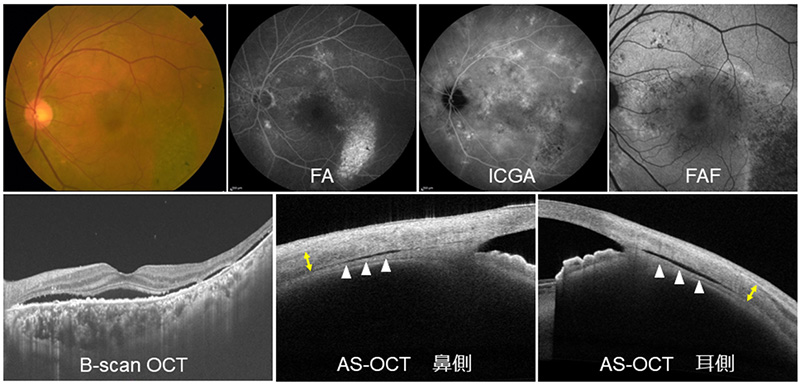 CSC眼のマルチモーダルイメージング